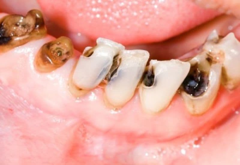 Việc nhận biết sớm các dấu hiệu răng sâu sẽ giúp quá trình chăm sóc răng bị sâu trở nên hiệu quả và tối ưu hơn.