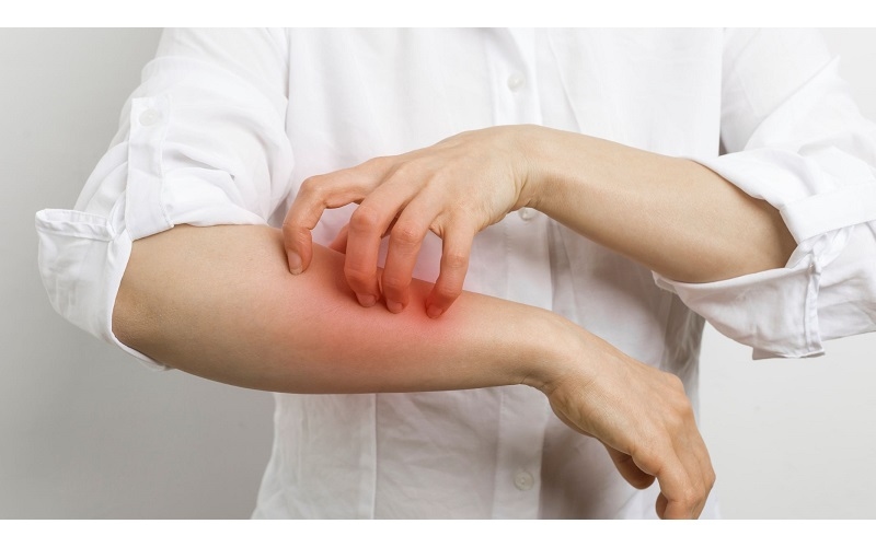 Thống kê cho thấy hơn một nửa số người mắc hen có biểu hiện của tạng Atopy - tình trạng cơ thể dễ phản ứng với các dị nguyên từ môi trường