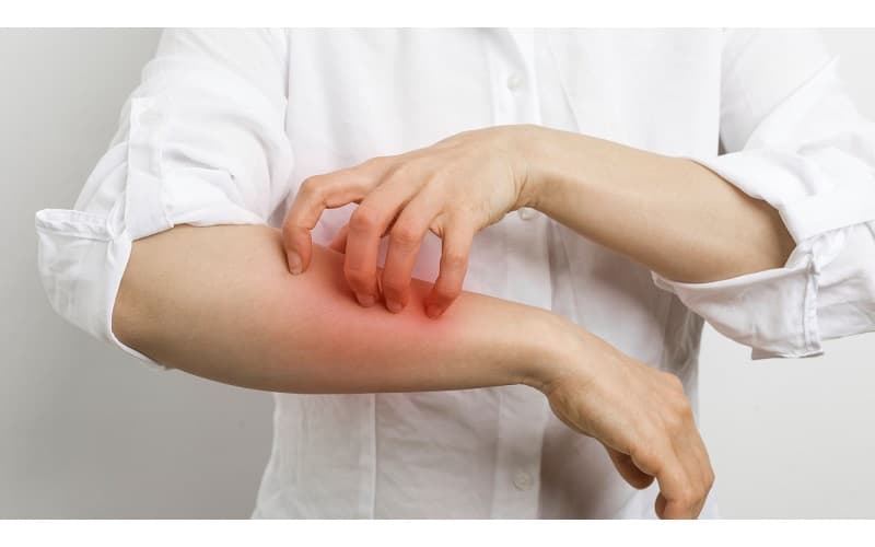 Thống kê cho thấy hơn một nửa số người mắc hen có biểu hiện của tạng Atopy - tình trạng cơ thể dễ phản ứng với các dị nguyên từ môi trường