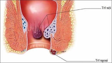 Chữa trĩ nội tại nhà: “Lợi bất cập hại” nếu không đúng cách