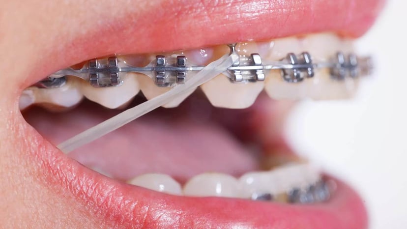 Có nên niềng răng và phương pháp phù hợp