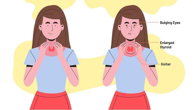 Cường giáp là bệnh gì, có nguy hiểm không?