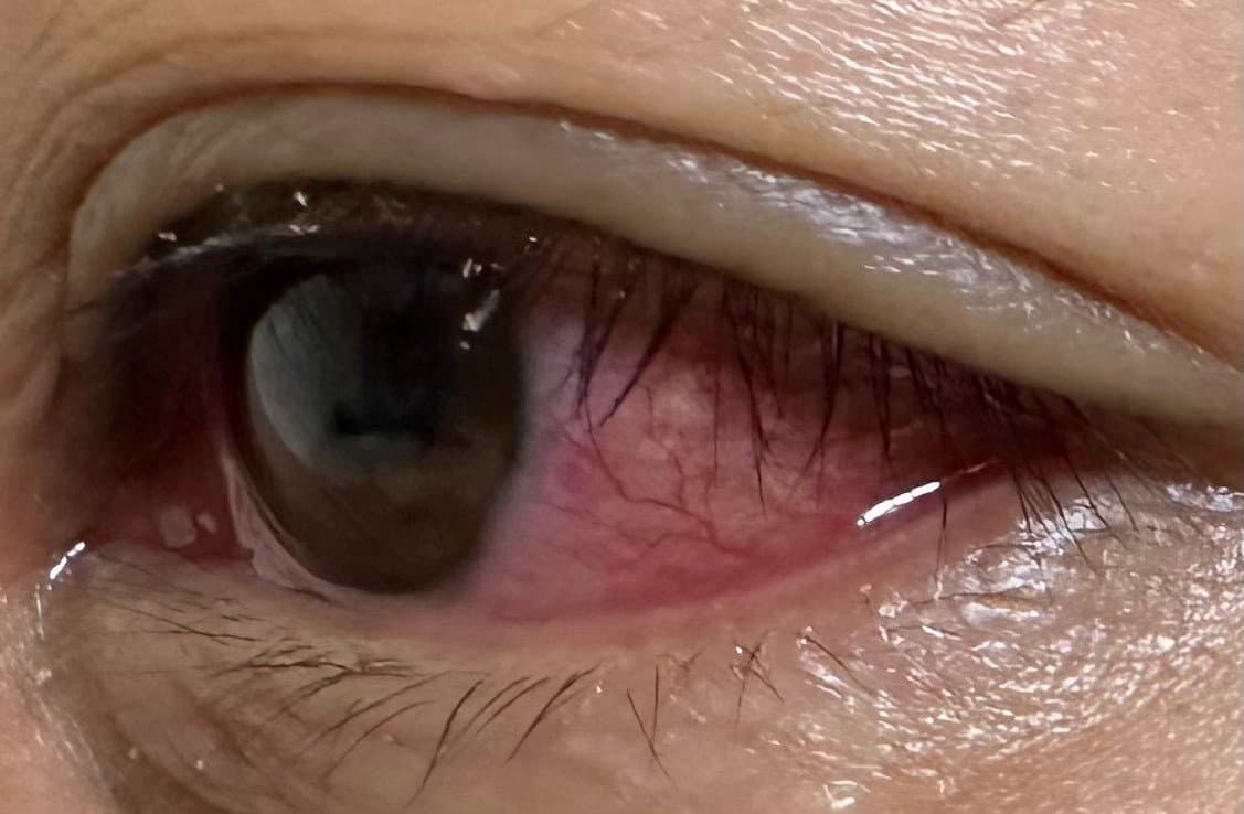 Đau mắt đỏ có thể do nhiều nguyên nhân như vi khuẩn, virus hoặc dị ứng.