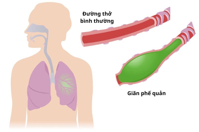 giãn phế quản là gì