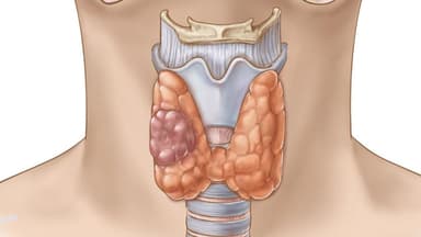 Giải đáp: Ở giai đoạn 3 ung thư tuyến giáp có chữa được không