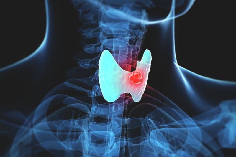 Các loại u tuyến giáp