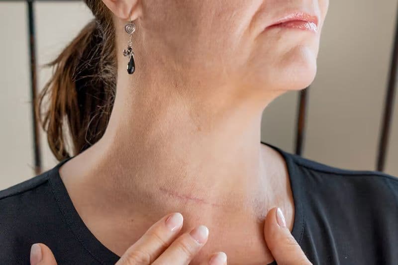 phương pháp điều trị u tuyến giáp