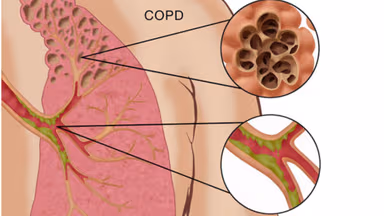 Góc giải đáp phổi tắc nghẽn mãn tính có nguy hiểm không