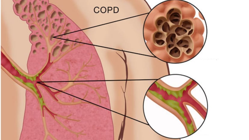 Góc giải đáp phổi tắc nghẽn mãn tính có nguy hiểm không