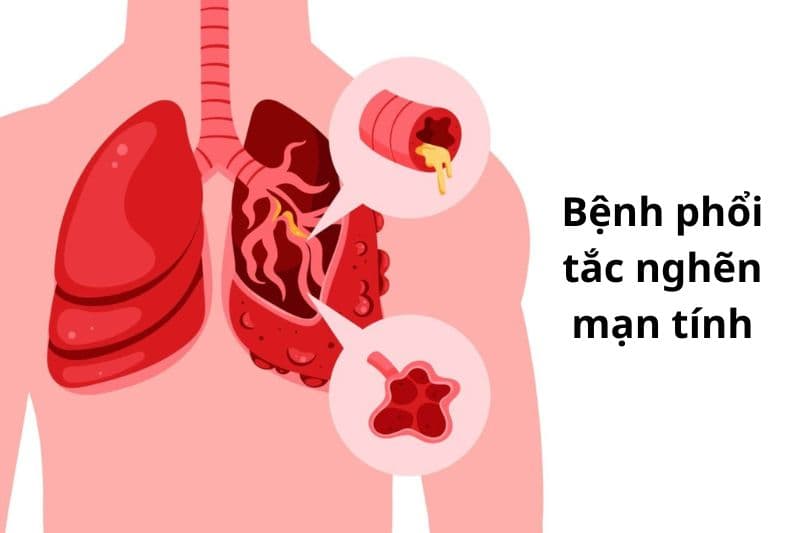 bệnh phổi tắc nghẽn mạn tính (copd)