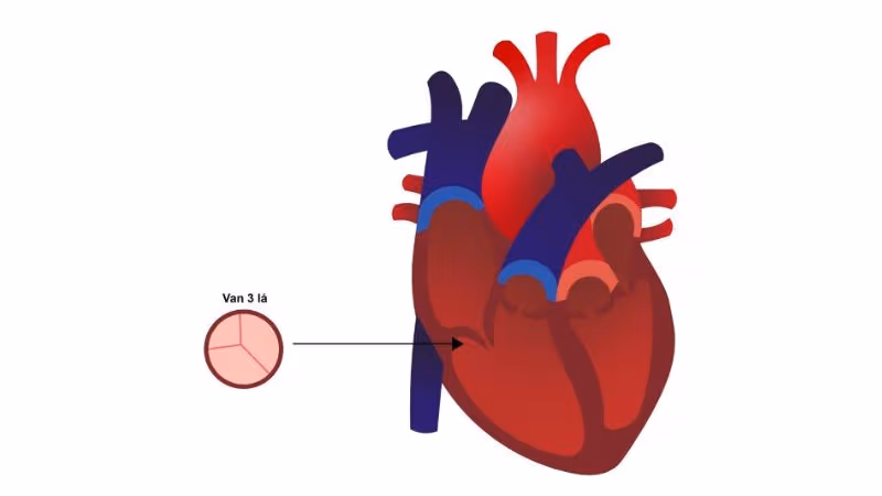 Hở van tim 3 lá là bệnh gì?
