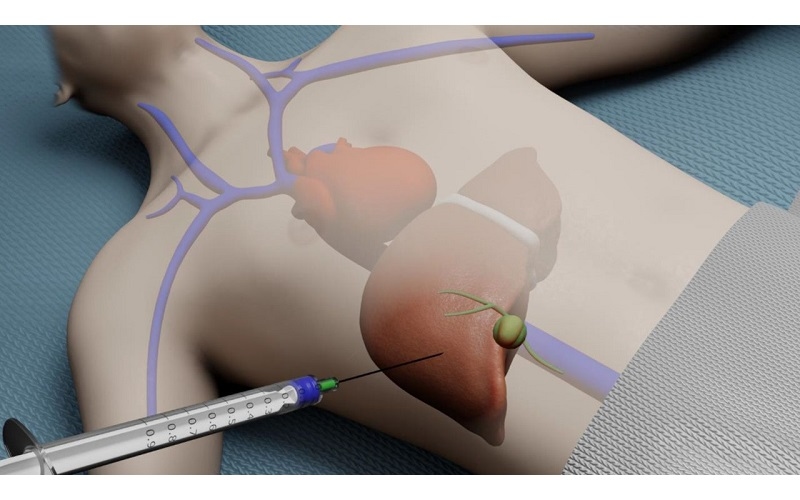 Trong một số trường hợp chưa rõ ràng, bác sĩ có thể chỉ định lấy mẫu mô gan để quan sát dưới kính hiển vi nhằm xác định tính chất tế bào và khẳng định chẩn đoán