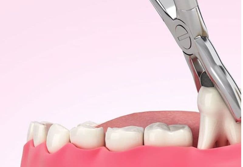 Một trong những câu hỏi phổ biến nhất tại nha khoa chính là: khi nào nhổ răng khôn