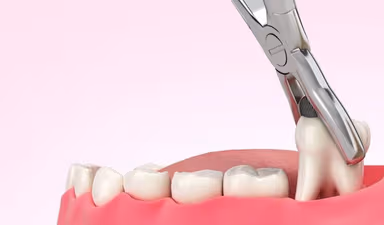 Giải đáp: Khi nào nhổ răng khôn để tránh biến chứng nguy hiểm