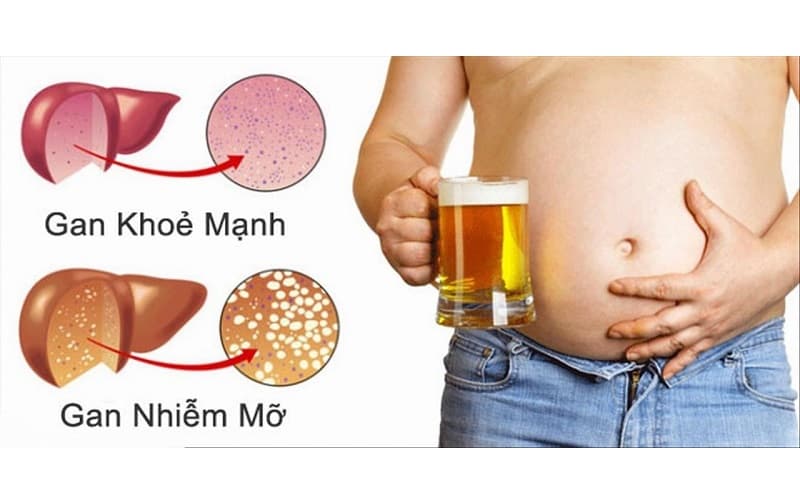Yếu tố gây nguy cơ ung thư gan