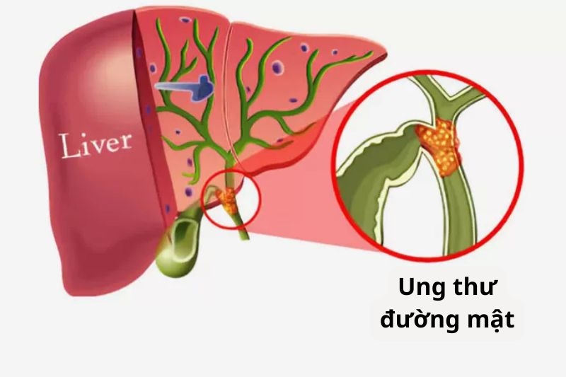 ung thư biểu mô đường mật và nguy cơ