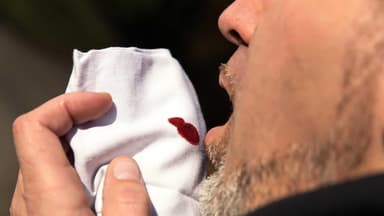 Nguyên nhân gây bệnh lao phổ biến nhưng ít người biết