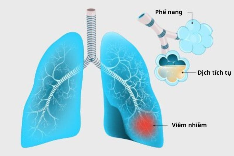 dịch tụ màng phổi