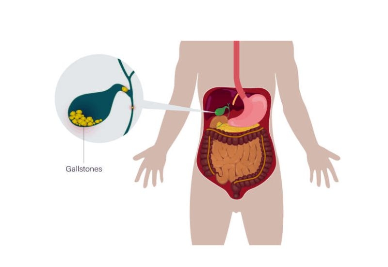 Những nguyên nhân phổ biến gây tắc ống mật