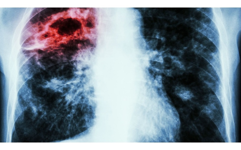 Triệu chứng của áp xe phổi thường tiến triển âm thầm qua nhiều tuần lễ và có thể chia thành từng giai đoạn cụ thể