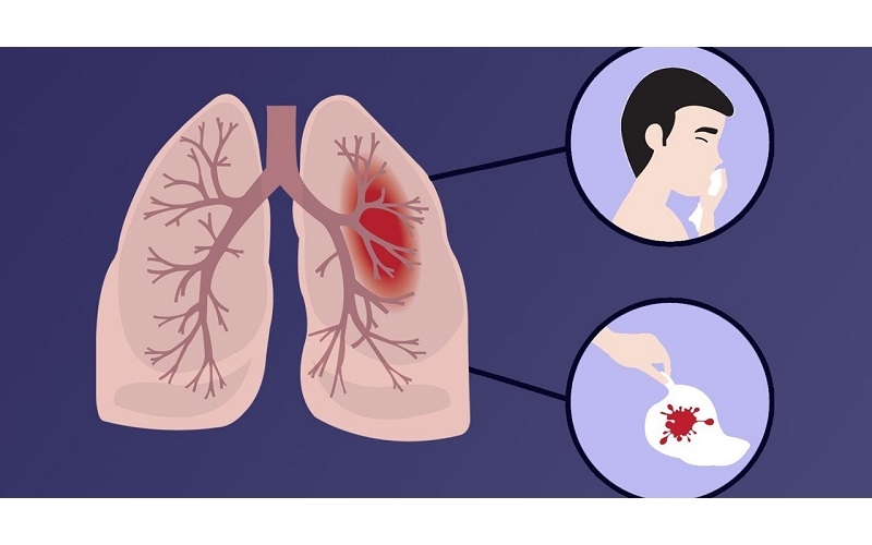 Ngoài ra, còn có các vi khuẩn như phế cầu khuẩn, liên cầu nhóm A, vi khuẩn Gram âm như Pseudomonas aeruginosa, Haemophilus influenzae… cũng là nguyên nhân tiềm ẩn gây áp xe phổi trong nhiều trường hợp.