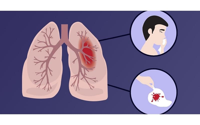 Ngoài ra, còn có các vi khuẩn như phế cầu khuẩn, liên cầu nhóm A, vi khuẩn Gram âm như Pseudomonas aeruginosa, Haemophilus influenzae… cũng là nguyên nhân tiềm ẩn gây áp xe phổi trong nhiều trường hợp.