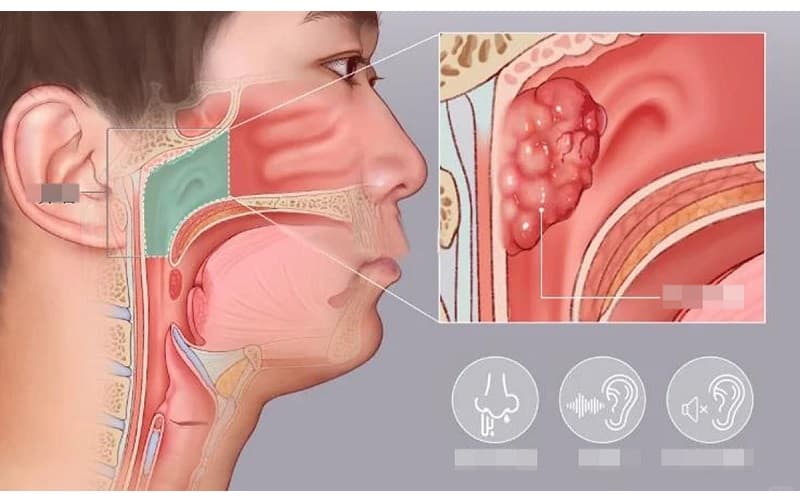 ung thư vòm mũi họng