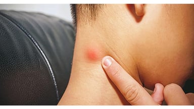 Nhận ra sớm ung thư vòm mũi họng để kịp phòng ngừa