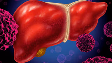 Tìm hiểu về ung thư gan: Vì sao nhiễm viêm gan B nên cảnh giác