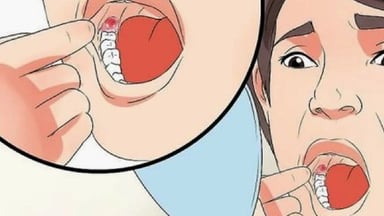 Nhổ răng khôn sau bao lâu thì hết chảy máu – Kinh nghiệm cần biết