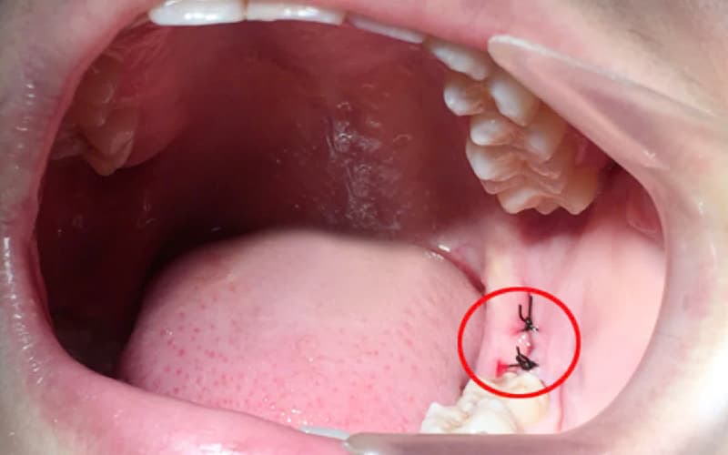 Thời gian tối đa Nhổ răng khôn sau bao lâu thì hết chảy máu