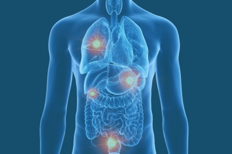 biến chứng u gan khi di căn