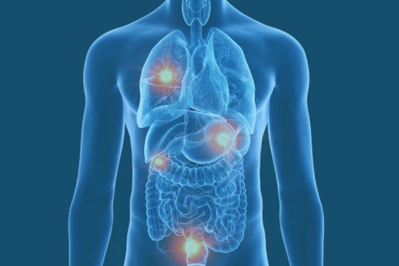 biến chứng u gan khi di căn