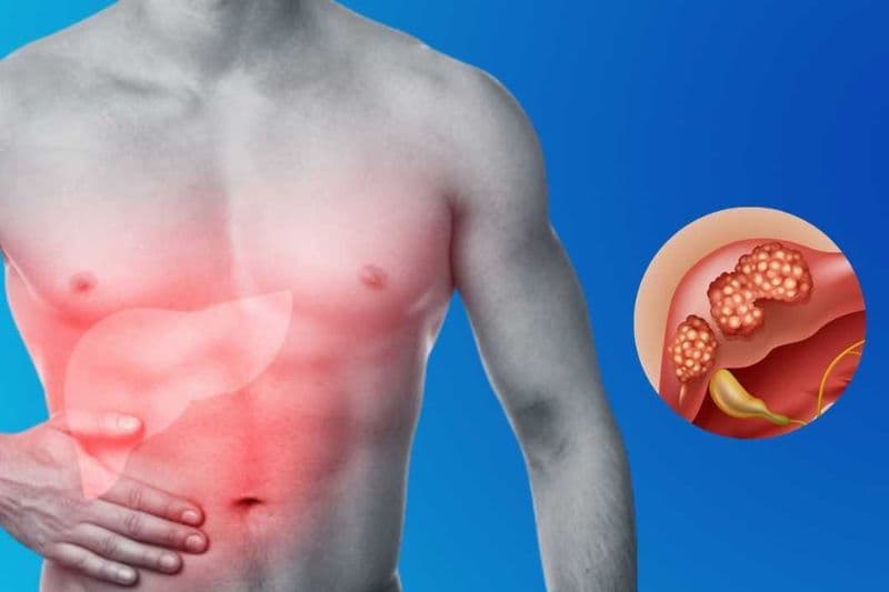 ung thư gan bị hoại tử