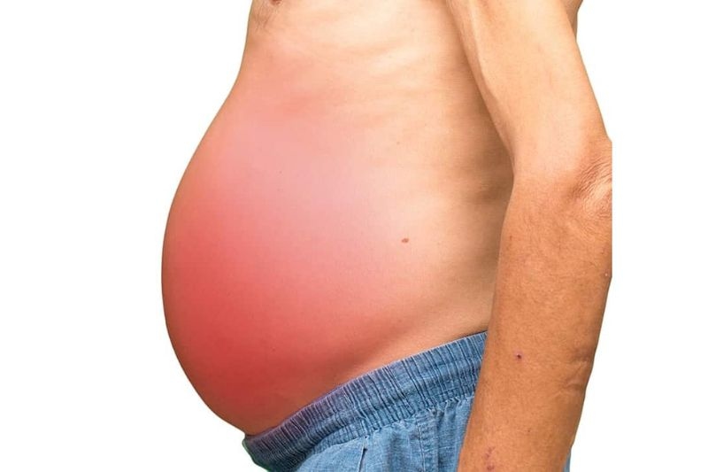 triệu chứng khi ung thư gan hoại tử