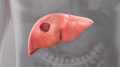 Bỏ túi những điều cần biết về ung thư gan