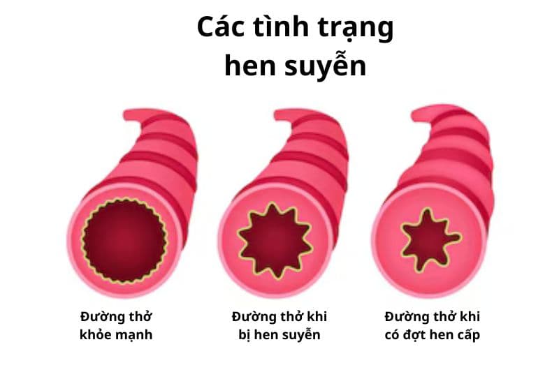 tình trạng hen suyễn