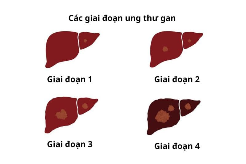 bệnh ung thư gan giai đoạn I cần chú ý