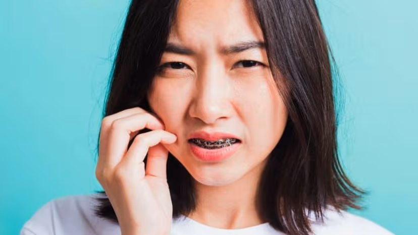 Niềng răng đau không – Một số giai đoạn cần chú ý