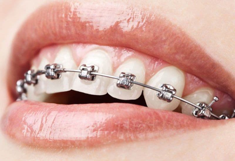 Niềng răng khấp khểnh giúp nắn chỉnh răng lệch, chen chúc, cải thiện thẩm mỹ và ăn nhai.