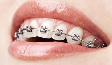 Các phương pháp niềng răng khấp khểnh phổ biến hiện nay