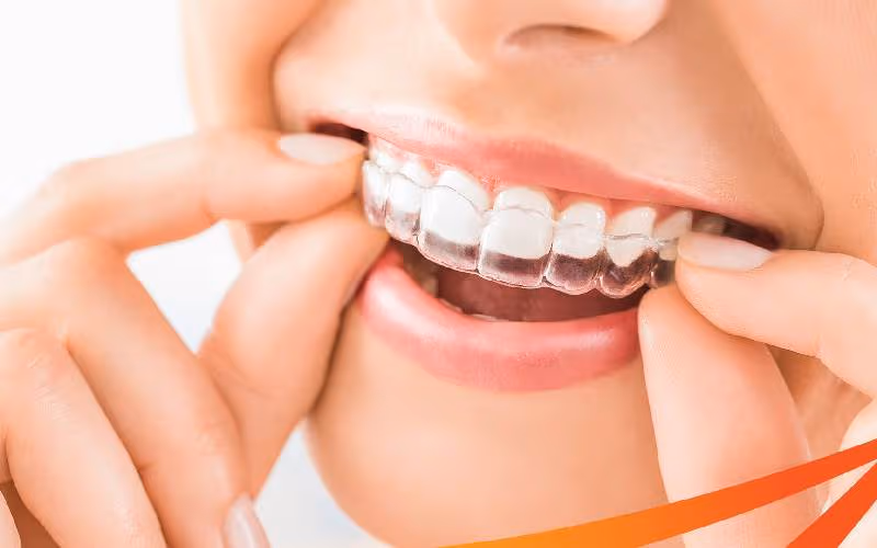 Niềng răng trong suốt Invisalign là gì