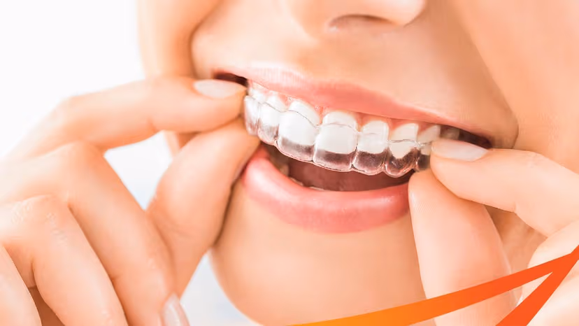 Niềng răng trong suốt Invisalign – Những điều nên biết sớm