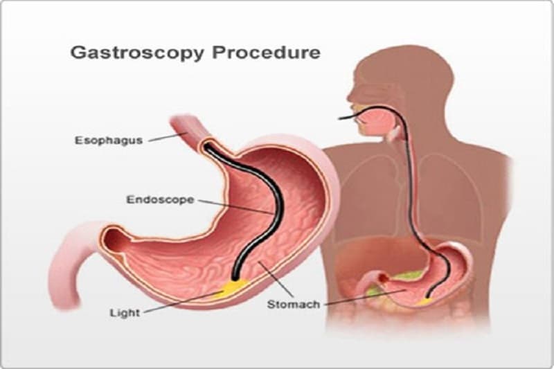 Ống nội soi gắn camera siêu nhỏ giúp phát hiện các tổn thương trong dạ dày.