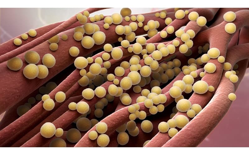 Áp xe phổi là một dạng nhiễm trùng nghiêm trọng, đặc trưng bởi sự xuất hiện của một hoặc nhiều ổ mủ bên trong nhu mô phổi