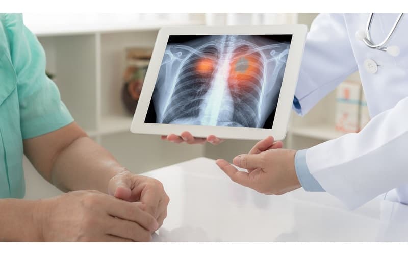 Áp xe phổi là một dạng viêm cấp tính xảy ra ở nhu mô phổi (phần mô chức năng của phổi), không liên quan đến bệnh lao