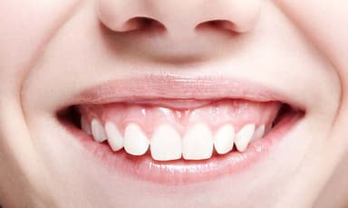 Điều trị cười hở lợi bằng laser – Giải pháp lấy lại nụ cười tự tin