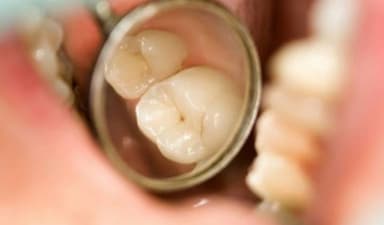 Răng sâu nhẹ – dấu hiệu nhận biết và cách điều trị sớm hiệu quả