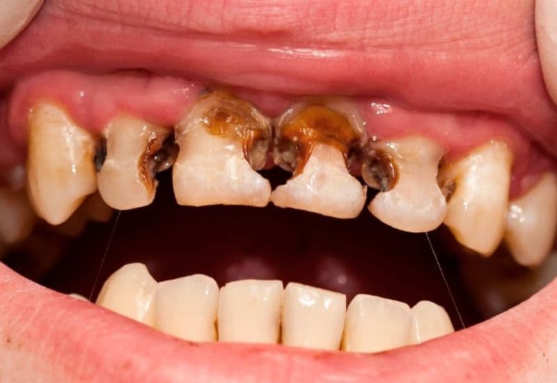 Sâu nhiều răng xảy ra khi vi khuẩn tấn công đồng loạt vào men và ngà của nhiều răng.