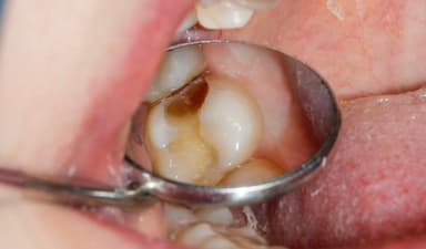 Sâu răng đến tủy: Dấu hiệu nhận biết và cách điều trị hiệu quả